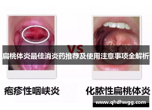 扁桃体炎最佳消炎药推荐及使用注意事项全解析